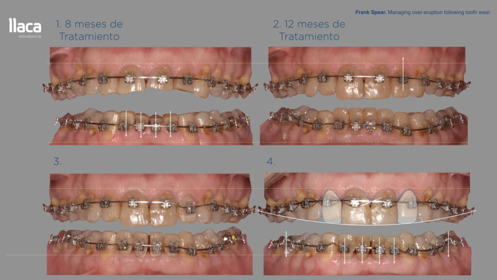 Evolución de un tratamiento de ortodoncia