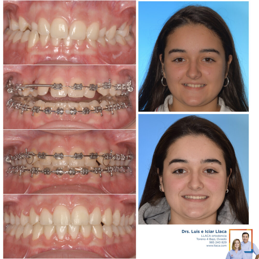 Dientes Incluidos o Impactados | Llaca Ortodoncia Oviedo