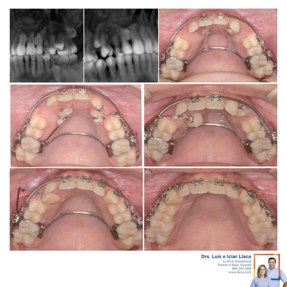 Dientes Incluidos o Impactados | Llaca Ortodoncia Oviedo