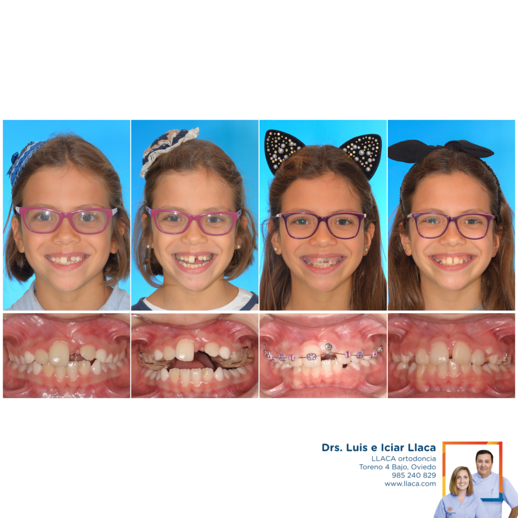 Dientes Incluidos o Impactados | Llaca Ortodoncia Oviedo